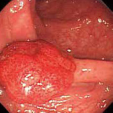 大腸CTでの検査の様子