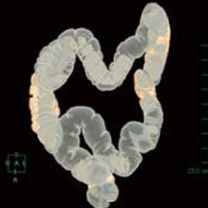 大腸CTでの検査の様子