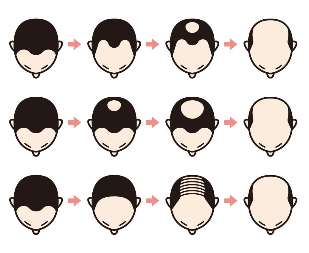 AGA(男性型脱毛症)の症状