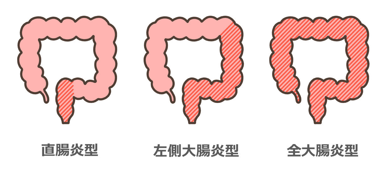 潰瘍性大腸炎3つのタイプ