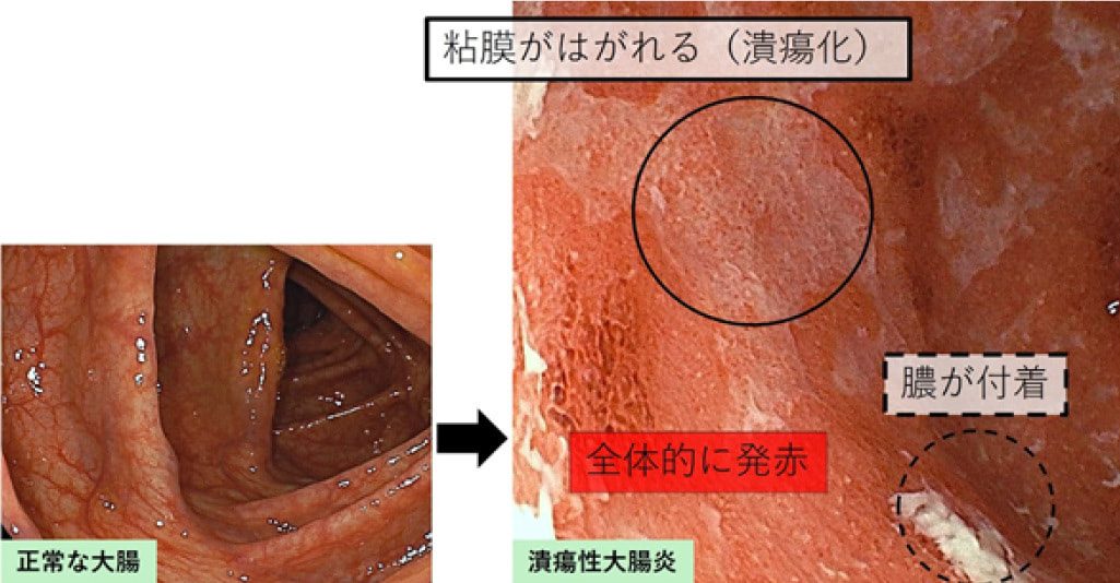 正常な大腸と潰瘍性大腸炎の違い