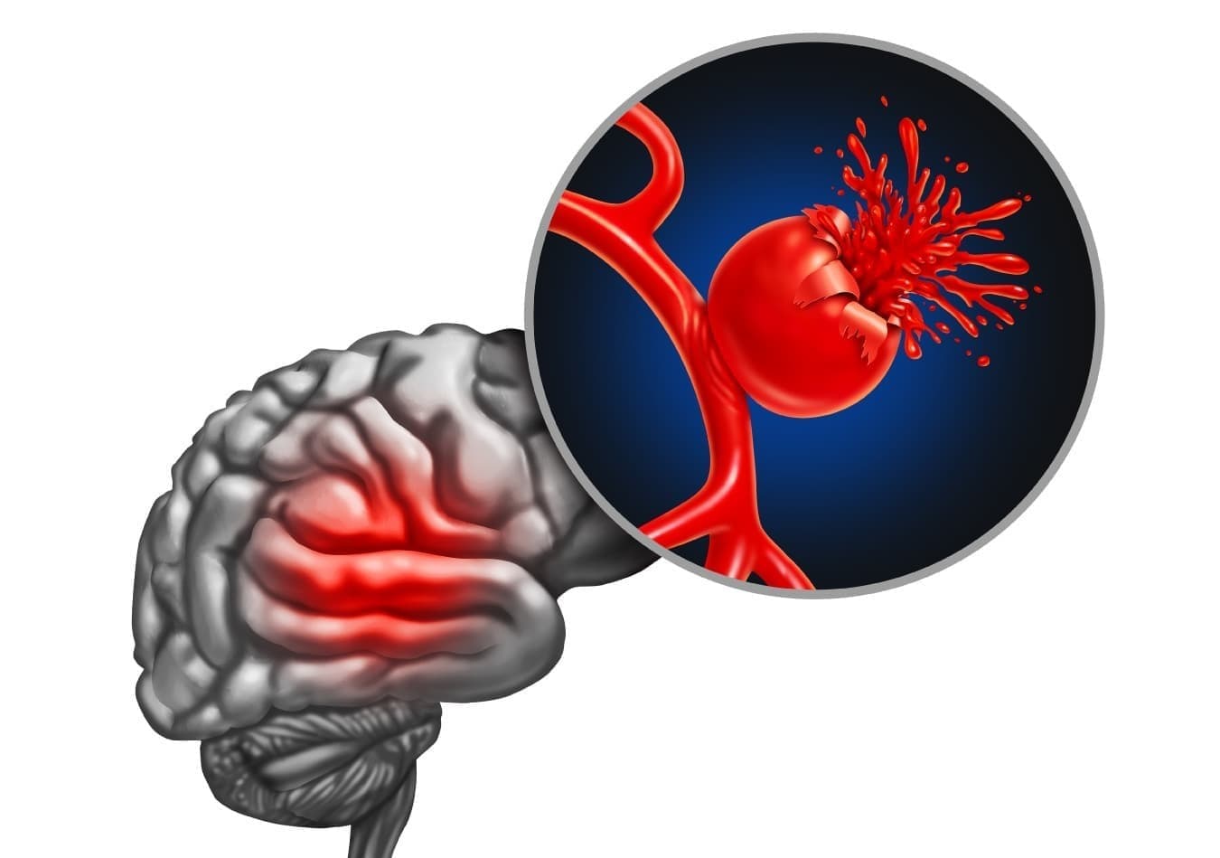 脳動脈瘤イメージ