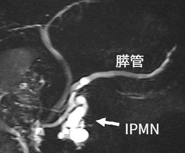 膵がんの前癌病変