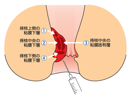 痔核の部位
