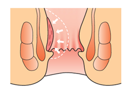 縮小する痔核の様子
