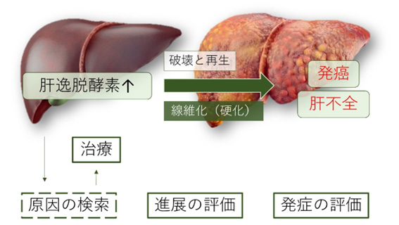 肝機能異常のイメージ